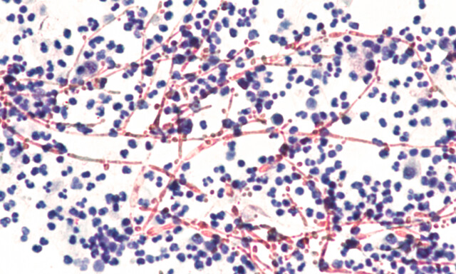 SOPPTRÅDER: Slik ser candida albicans ut i mikroskopet. Lange grenede tråder, her farget i rødt. FOTO: NTB scanpix / Shutterstock / David A Litman SOPPTRÅDER: Slik ser candida albicans ut i mikroskopet. Lange grenede tråder, her farget i rødt. FOTO: NTB scanpix / Shutterstock / David A Litman